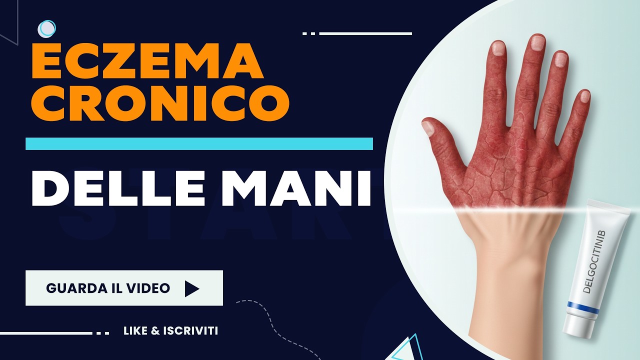 Delgocitinib è ora disponibile in Italia per l'eczema cronico delle mani