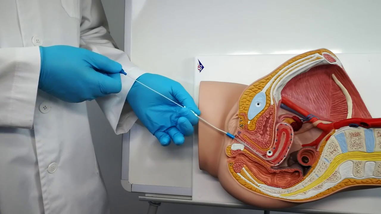 How to perform an endometrial liquid biopsy