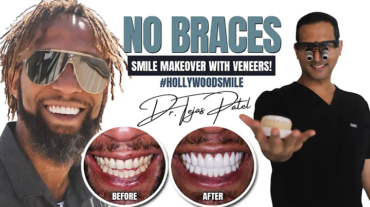 Hollywood Smile Before and After with Veneers by Dr. Tejas Patel