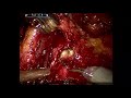 Core Videos (2018): Robotic Repair of Left Uretero