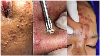 Extremely satisfying blackheads exfoliation, for blackheads and pimples TikTok compilation : pt. 6 :