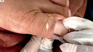 How to Repair Nails easy # 472 - Xuyen Nail