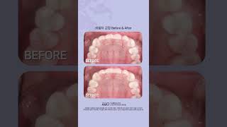 발치 없이 교정하자! 비발치교정 #shorts