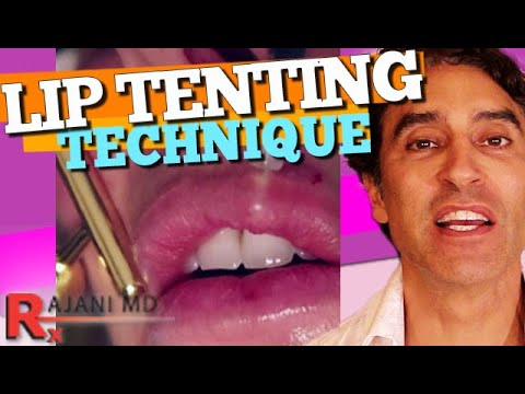 LIP FILLER RUSSIAN TENTING TECHNIQUE Demonstrated - Lip Filler Before and After