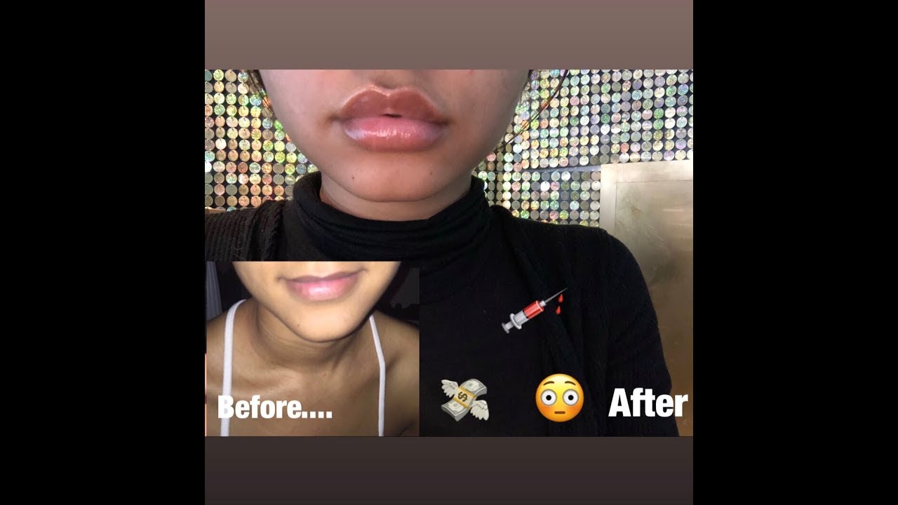 THE TRUTH ABOUT LIP FILLERS | MY BAD EXPERIENCE