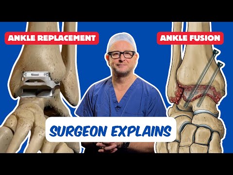 Which is better, an ankle replacement or an ankle fusion?
