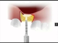 Bone compression kit   sinus augmentation technique