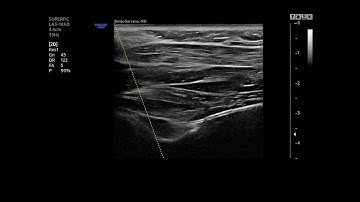 Suprascapular nerve block - distal approach