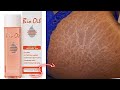 Bio Oil Review- Does Bio Oil Actually Work On Strech Marks And Scars? (bio oil before and after)
