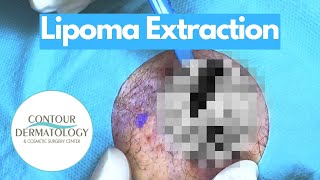 Lipoma Extracted & Dissected! | CONTOUR DERMATOLOGY