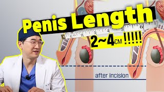 Penis Lengthening Surgery - Common Q&A with A Urologist