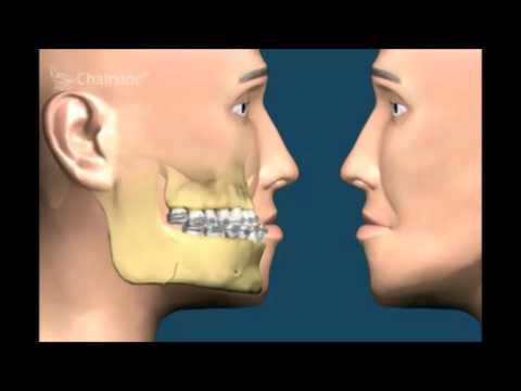 Видео: Хирургия челюсти: процедура, стоимость и что ожидать