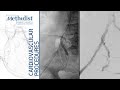 Internal Iliac Bifurcation VBX for Buttock Claudication (Alan Lumsden, MD, Ponraj Chinnadurai, MBBS)