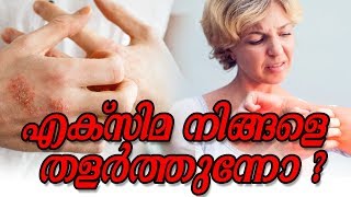 എക്സിമ നിങ്ങളെ തളർത്തുന്നോ Healthy kerala | Skin care | Skin tips | Eczema care | Skin | Beauty