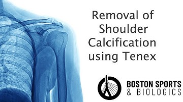 Minimally Invasive Treatment for Shoulder Calcifications: Tenex Procedure