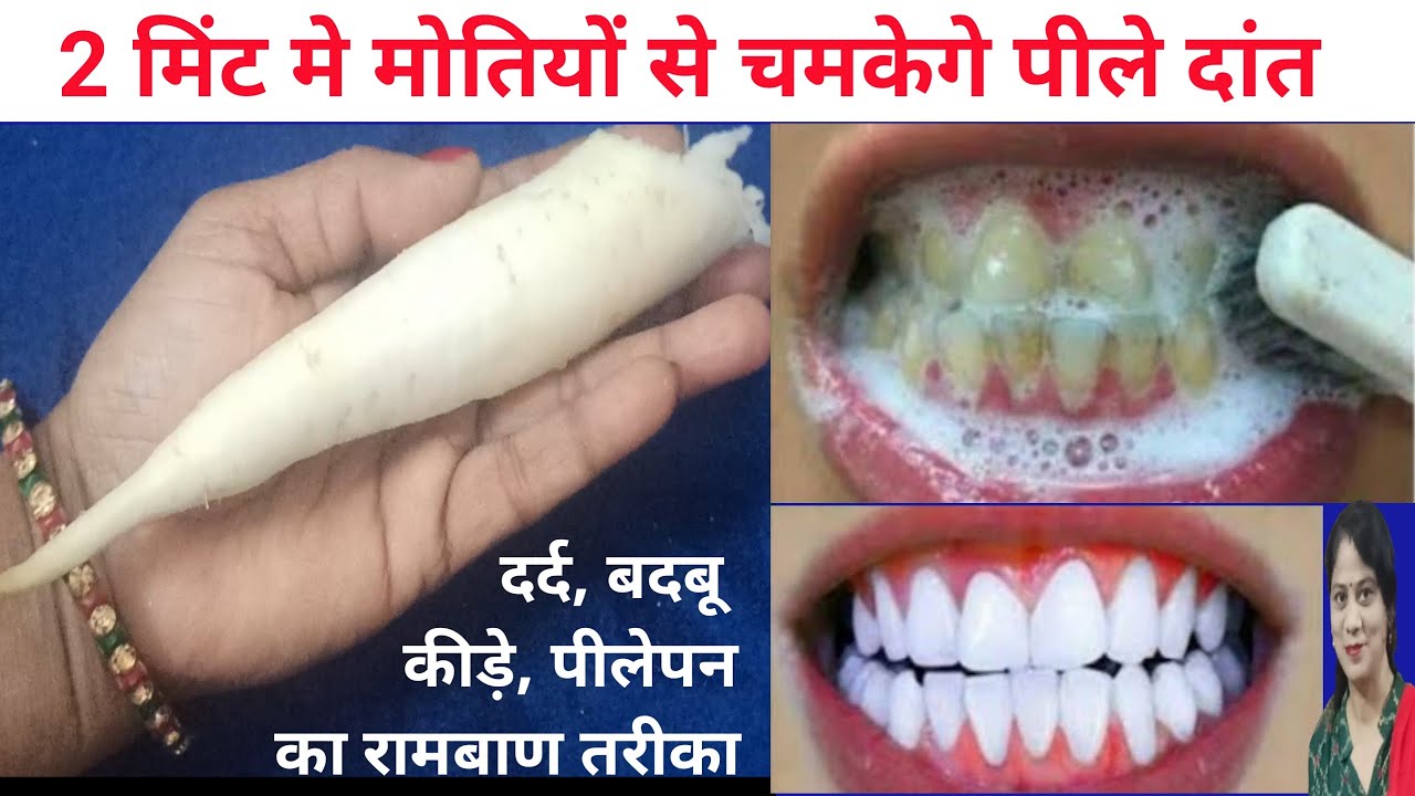 सिर्फ 1 मिनट में गंदे पीले दांतो को मोती की तरह चमका देगा यह नुस्खा