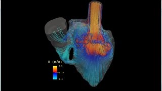Can we simulate blood flows to improve heart surgery?