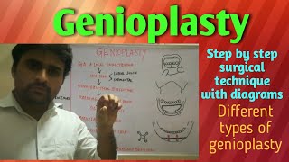 Genioplasty