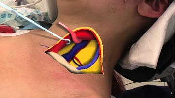 Brachial plexus incision movie