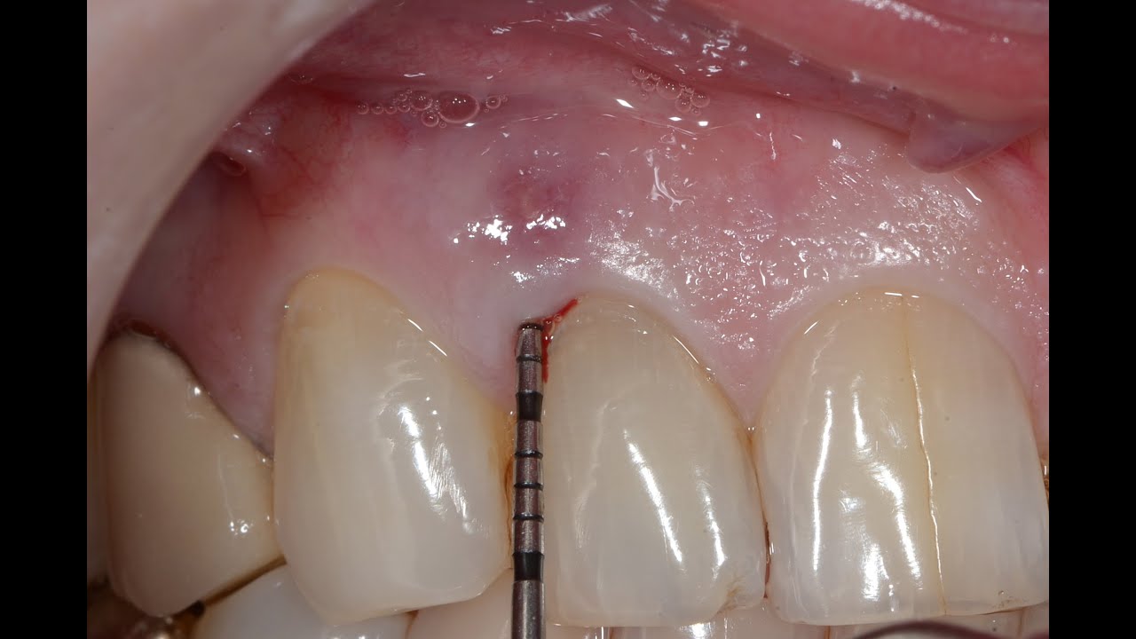 Periodontal Surgery with Regenerative Therapy. YouTube