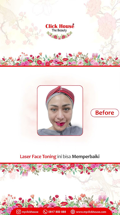 DHEA ZAUTHA: 'Masalah Kulit Wajah Aku Dapat Teratasi' - LASER FACE TONING ❤️ #shorts