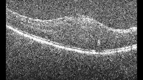 Spectral-Domain Optical Coherence Tomography of Macular Epiretinal Membrane in Neurofibromatosis Typ