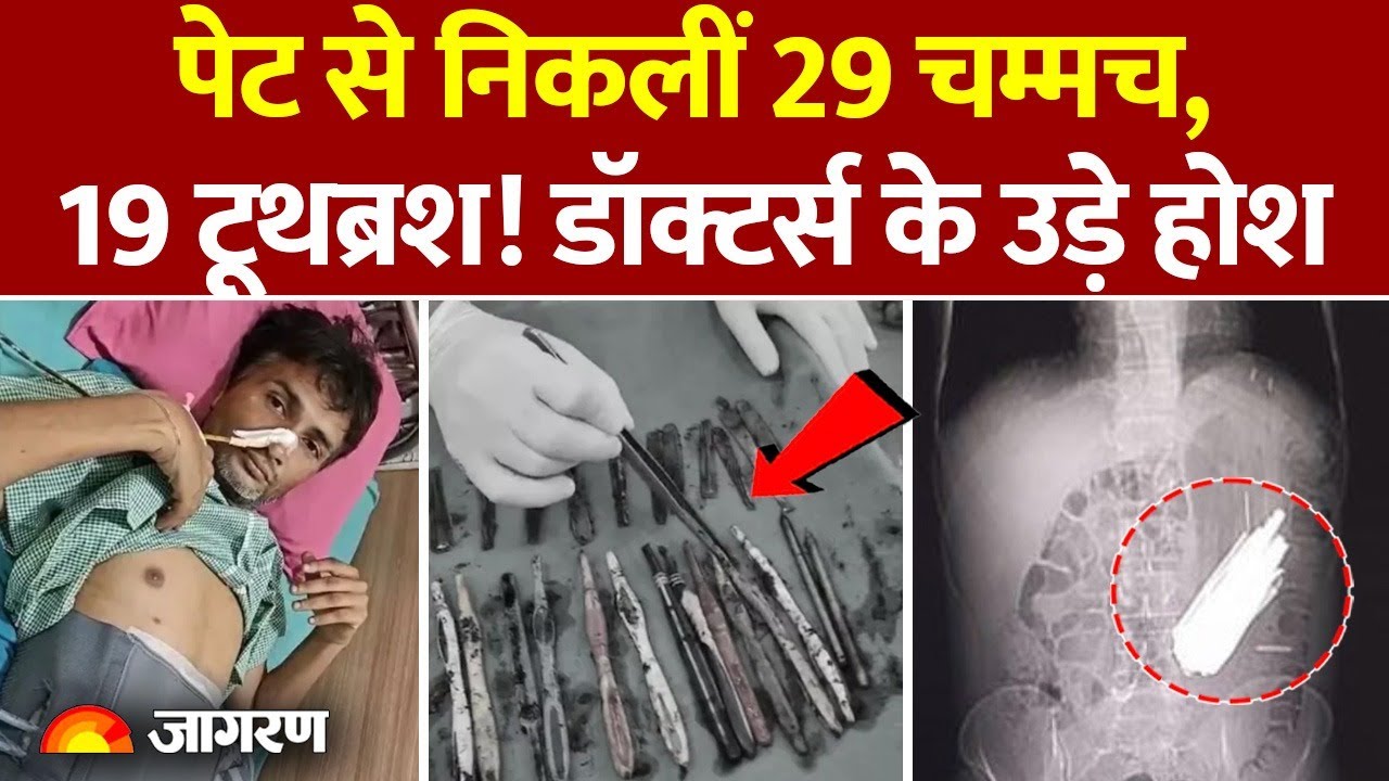 Hapur News: युवक के पेट से निकलीं 29 spoons-19 toothbrush और 2 Pen|  