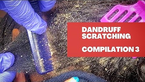 Dandruff Scratching Compilation 3 | Scratching Flakes From Scalp | #dandruffscratching