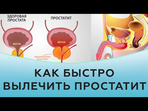 Простатит. Как быстро вылечить воспаление простаты.