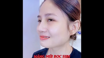 Nâng mũi bọc sụn - Có ngay dáng mũi đẹp "không góc chết"
