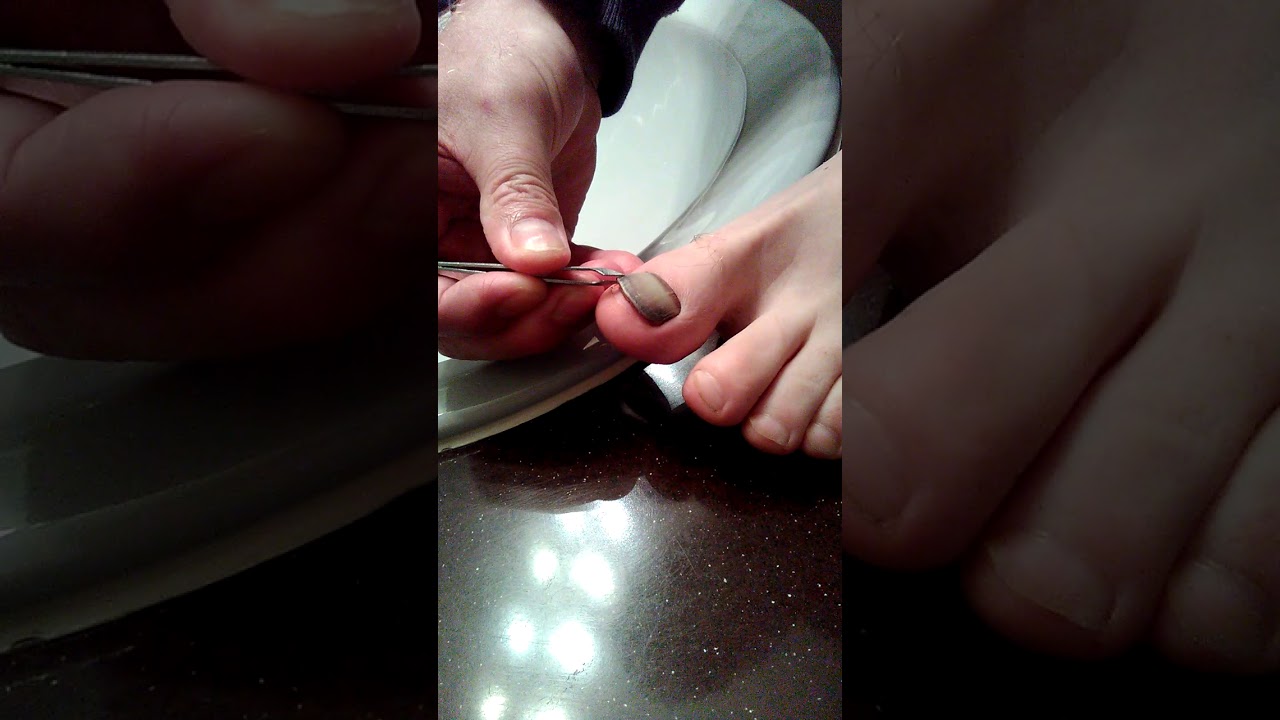 My dad pulled off his toenail!! YouTube