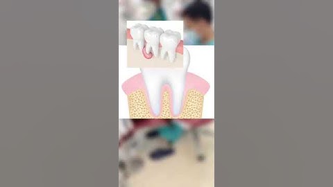 #42 Bọc răng sứ rồi thì liệu có niềng răng được hay không | NHA KHOA LÊ ĐÔNG #shorts