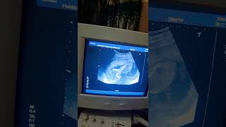 baby in danger of miscarriage