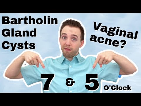 Video: Puas bartholin cyst tsw tsw?