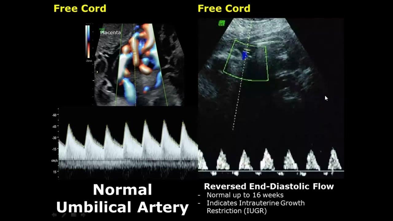 umbilical-artery-doppler-ultrasound-normal-vs-abnormal-image