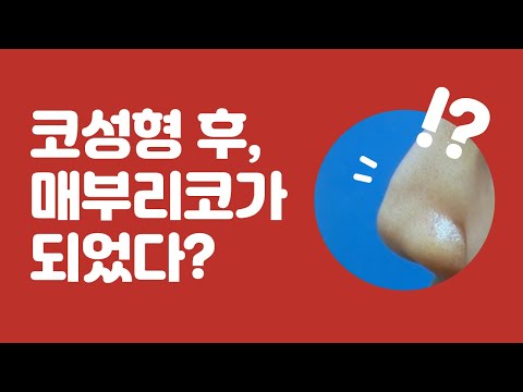 코성형 후 매부리코가 되었다!?