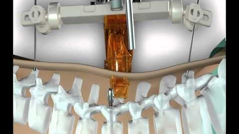 Mazor Robotics. Spine Assist. Introduction