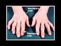 Arthritis Overview - RA/OA/What to Avoid