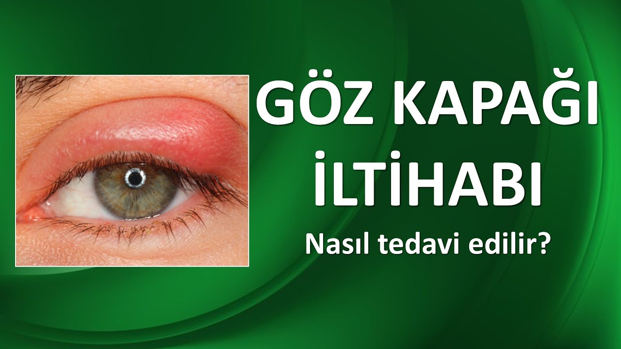 BLEFARİT GÖZ KAPAĞI İLTİHABI NEDİR? NASIL TEDAVİ EDİLİR?