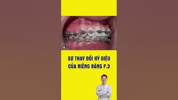 Sự thay đổi kỳ diệu của Niềng răng P3 #nhakhoa #bacsidieutaithu #shorts  #drthu #niengrang