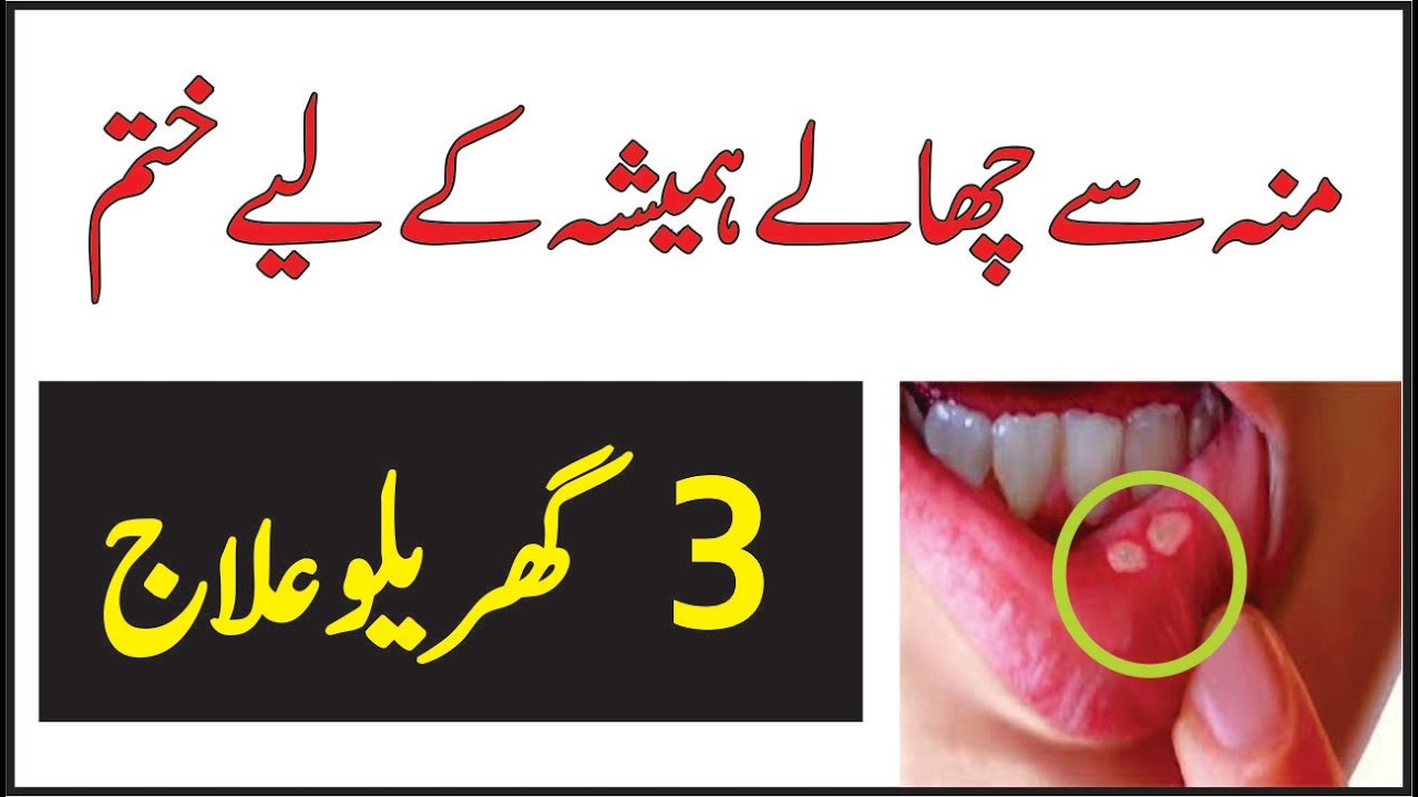 Mou k Chalay ka ilaj in Urdu Mouth blisters treatment in Urdu Health Tips in Hindi Desi