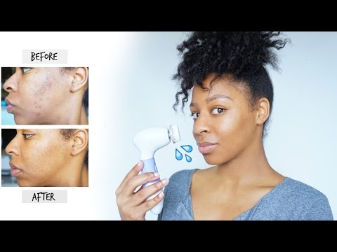 How I Remove Dark Spots & Acne Scars | Skincare Routine for Hyperpigmentation