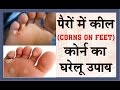 corn on feet home remedy hindi