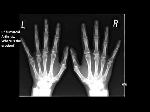 Image of the Month April 2011: Rheumatoid Arthritis X-Ray