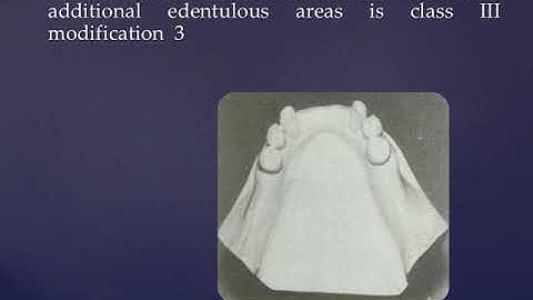 American Made Removable Partial Denture