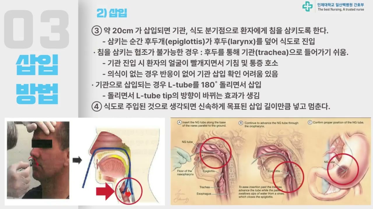L tube 삽입│일산백병원 간호부 교육영상