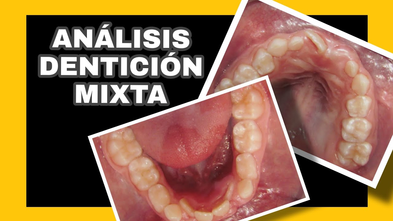 Análisis de dentición mixta - YouTube