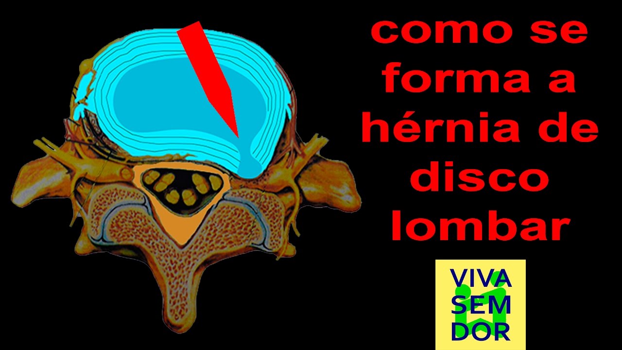 artrose no joelho como se forma a hérnia de disco lombar