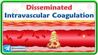 Disseminated Intravascular coagulation (Animation)  : Pathogenesis, Morphology, Diagnosis, Treatment
