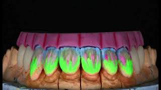 Porcelain Veneers layering by master ceramist